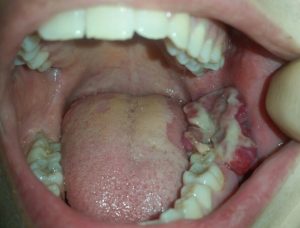 Gros épulis chez une femme enceinte sous progesterone, au niveau de la dent de sagesse inférieure.