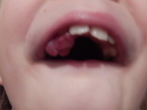 Epulis chez un enfant de 6 ans.