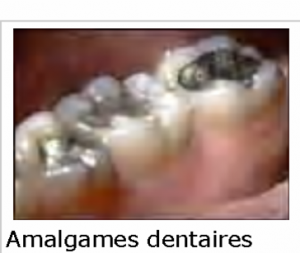 AMALGAMES (lasanté-dentaire.blogspot.com)