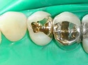 Inlays métaliques scéllés en place 'french.dentalceramiclaboratory.com)
