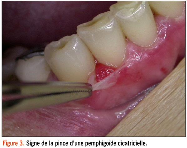 Pemphigoïde( JIM.fr).