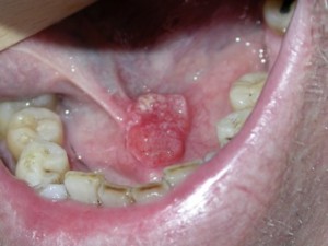 Carcinome épidermoïde sublingual (maxillo-paris.com)