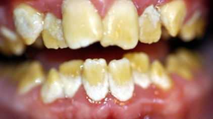 Amélogénèse imparfaite de la deuxième dentition (universitederennes1).