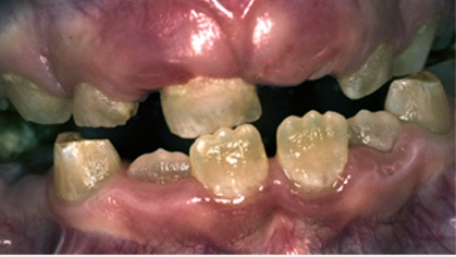 Dentinogénèse imparfaite Uninervité de Rennes 1).