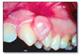 Granulome périphérique à cellules géantes (dentalcare.fr).