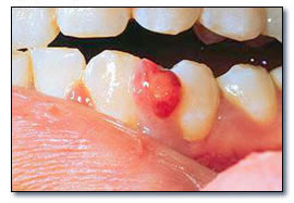 Granulome pyogène (dentalcare.fr).