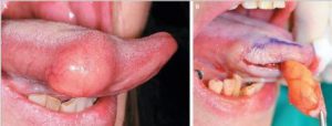 Lipome ligual et exérèse chirurgicale (Mécecine Intérée).
