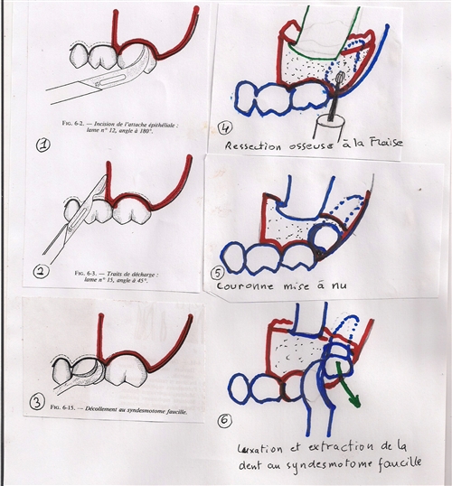 Extractions Des Dents De Sagesse Supérieurs. — Conseil Dentaire Dr ...