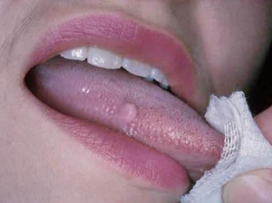 papillomavirus et bouche stadiul invaziv al pinworm